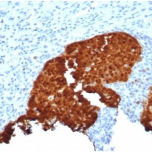 Formalin-fixed, paraffin-embedded human cervix stained with P16INK4a Recombinant Rabbit Monoclonal Antibody (CDKN2A/4844R).