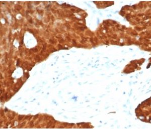 Formalin-fixed, paraffin-embedded human ovarian carcinoma stained with P16INK4a Recombinant Rabbit Monoclonal Antibody (CDKN2A/7081R).