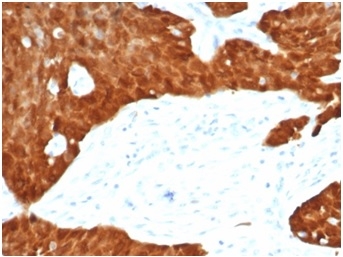 Formalin-fixed, paraffin-embedded human ovarian carcinoma stained with P16INK4aRecombinant Rabbit Monoclonal Antibody (CDKN2A/7081R).