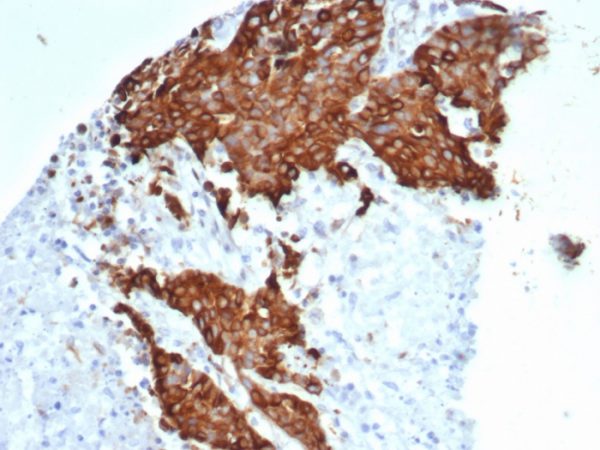 Formalin-fixed, paraffin-embedded human ovarian carcinoma stained with Tubulin beta 3 Recombinant Rabbit Monoclonal Antibody (TUBB3/7089R).