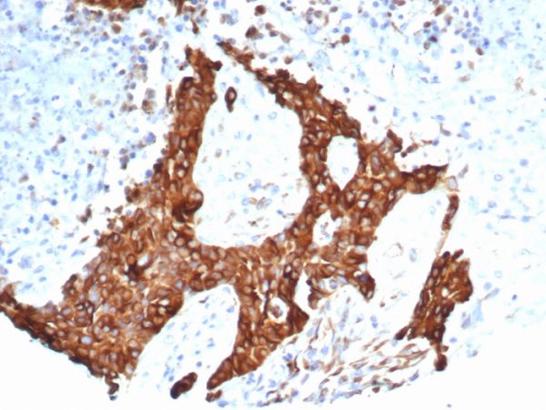 Formalin-fixed, paraffin-embedded human ovarian carcinoma stained with Tubulin beta 3 Recombinant Rabbit Monoclonal Antibody (TUBB3/7090R).