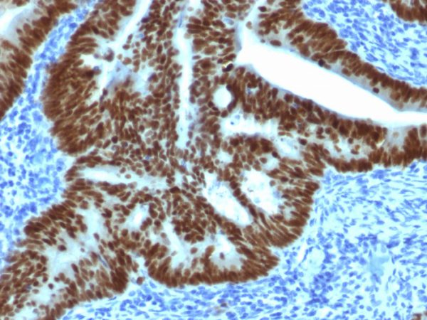 Formalin-fixed, paraffin-embedded human Colon Carcinoma stained with CDX2 Mouse Monoclonal Antibody (CDX2/1690).