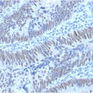 Formalin-fixed, paraffin-embedded human Colon Carcinomastained with CDX2 Mouse Monoclonal Antibody (PCRP-CDX2-1A3).