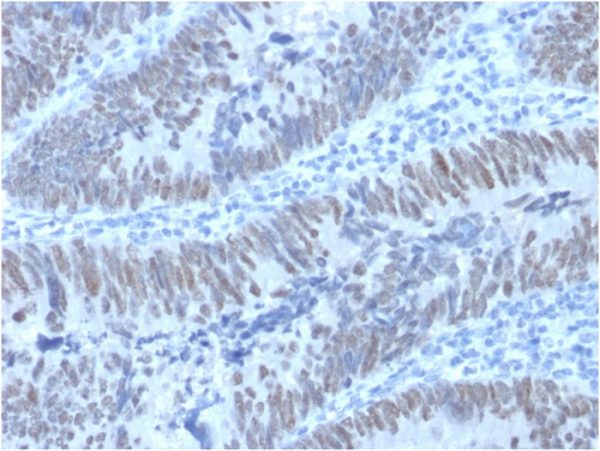 Formalin-fixed, paraffin-embedded human Colon Carcinomastained with CDX2 Mouse Monoclonal Antibody (PCRP-CDX2-1A3).