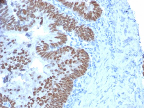 Formalin-fixed, paraffin-embedded human Colon Carcinoma stained with CDX2 Mouse Monoclonal Antibody (CDX2/2214).