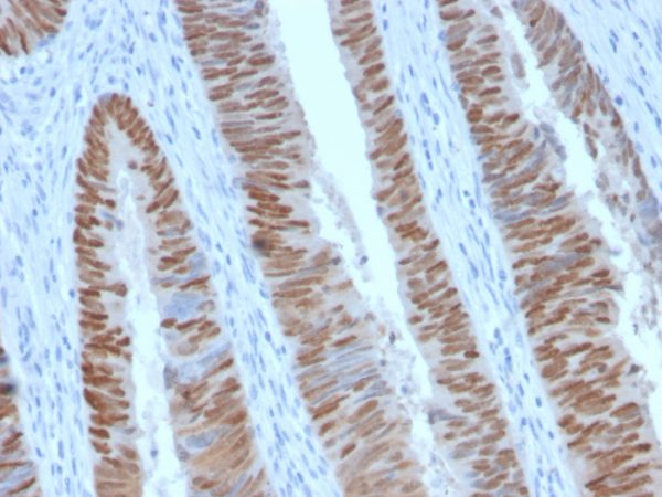 Formalin-fixed, paraffin-embedded human Colon Carcinoma stained with CDX2 Rabbit Recombinant Monoclonal Antibody (CDX2/2951R).
