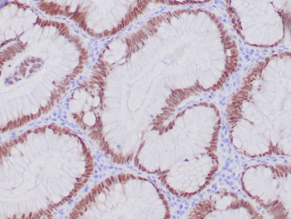 IHC analysis of formalin-fixed, paraffin-embedded human colon adenocarcinoma. Strong nuclear staining using CDX2/4394R at 2ug/ml in PBS for 30min RT. HIER: Tris/EDTA, pH9.0, 45min. 2°: HRP-polymer, 30min. DAB, 5min.