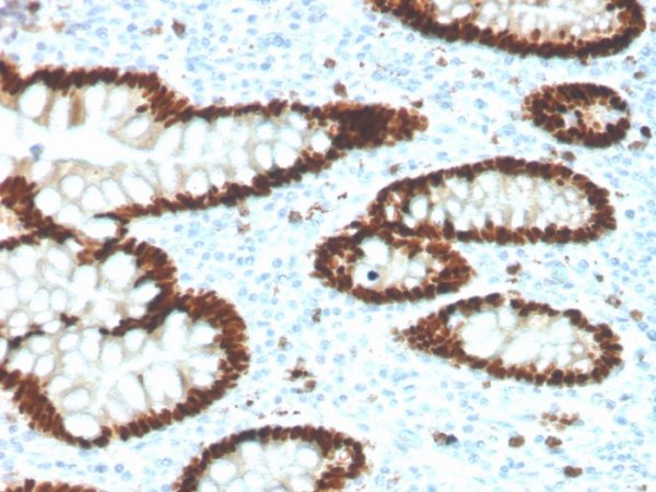 IHC analysis of formalin-fixed, paraffin-embedded human colon. Strong  nuclear staining using CDX2/4394R at 2ug/ml in PBS for 30min RT. HIER: Tris/EDTA, pH9.0, 45min. 2°: HRP-polymer, 30min. DAB, 5min.