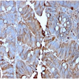 Formalin-fixed, paraffin-embedded human colon carcinoma stained with MerTK Mouse Monoclonal Antibody (MERTK/3015).