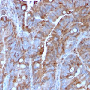 Formalin-fixed, paraffin-embedded human Colon Carcinoma stained with MerTK Mouse Monoclonal Antibody (MERTK/3022).