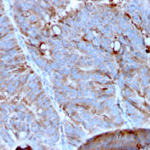 Formalin-fixed, paraffin-embedded human Colon Carcinoma stained with MerTK Mouse Monoclonal Antibody (MERTK/3023).