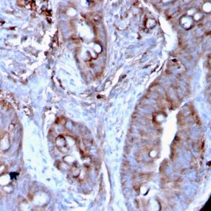 Formalin-fixed, paraffin-embedded human Colon Carcinoma stained with MerTK Mouse Monoclonal Antibody (MERTK/3024).