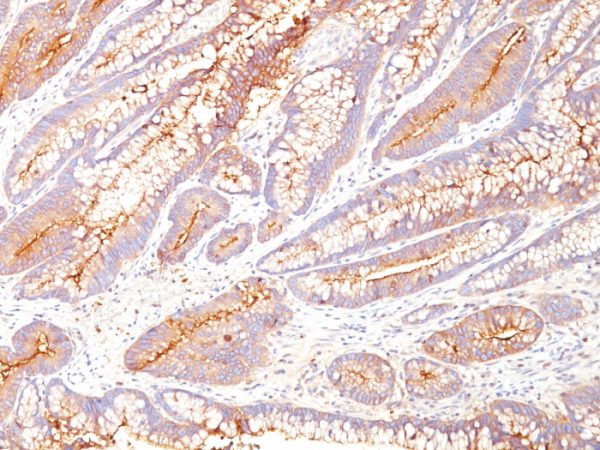 Formalin-fixed, paraffin-embedded human colon carcinoma stained with CEA Mouse Monoclonal Antibody (COL-1).