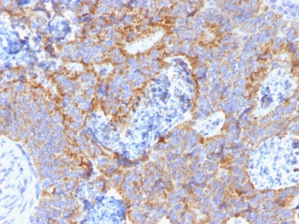 Formalin-fixed, paraffin-embedded human colon stained with CEA Mouse Monoclonal Antibody (C66/1291).