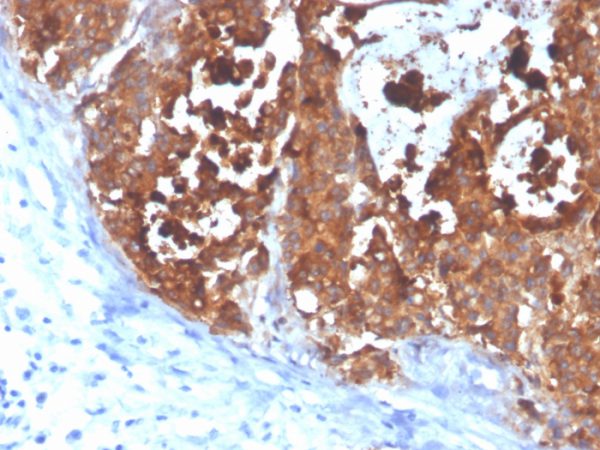 Formalin-fixed, paraffin-embedded human colon carcinoma stained with CEA Mouse Monoclonal Antibody (C66/4098).