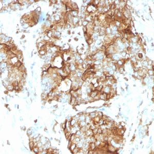 Formalin-fixed, paraffin-embedded human colon carcinoma stained with CEA Mouse Monoclonal Antibody (SPM584).