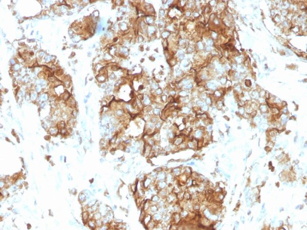 Formalin-fixed, paraffin-embedded human colon carcinoma stained with CEA Mouse Monoclonal Antibody (SPM584).