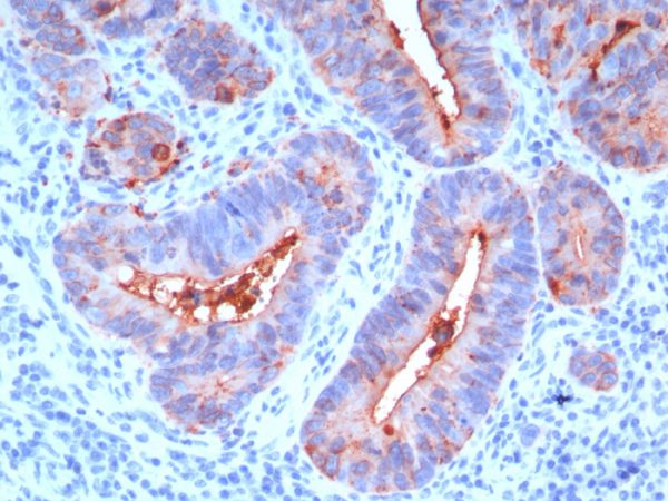 Formalin-fixed, paraffin-embedded human colon carcinoma stained with CEA Mouse Monoclonal Antibody (C66/195).