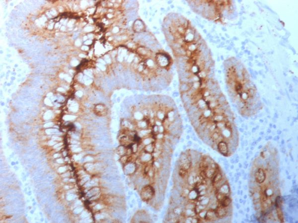 Formalin-fixed, paraffin-embedded human colon carcinoma stained with CEA Mouse Monoclonal Antibody (C66/261).