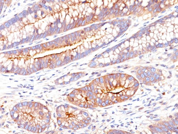 Formalin-fixed, paraffin-embedded human colon carcinoma stained with CEA Mouse Monoclonal Antibody (SPM551).