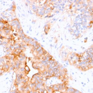 Formalin-fixed, paraffin-embedded human colon carcinoma stained with CEA Mouse Monoclonal Antibody (CEA31).