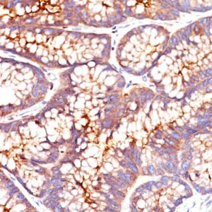 Formalin-fixed, paraffin-embedded human colon carcinoma stained with CEA Mouse Monoclonal Antibody (SPM541).