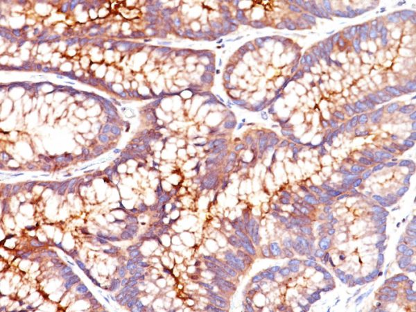 Formalin-fixed, paraffin-embedded human colon carcinoma stained with CEA Mouse Monoclonal Antibody (SPM541).