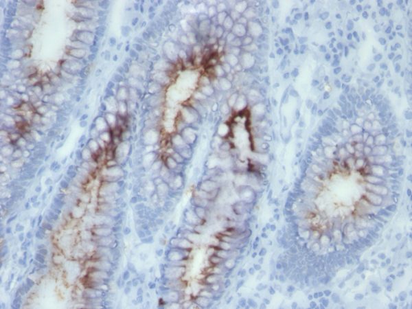 Formalin-fixed, paraffin-embedded human colon carcinoma stained with CEA Mouse Monoclonal Antibody (SPM506).