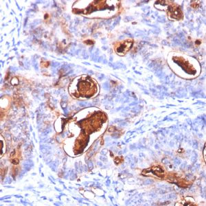 Formalin-fixed, paraffin-embedded human colon carcinoma stained with CEA Mouse Monoclonal Antibody (COL-1+CEA31+C66/261).