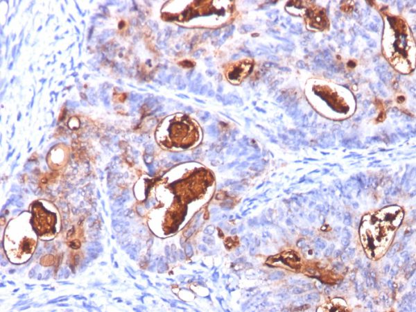 Formalin-fixed, paraffin-embedded human colon carcinoma stained with CEA Mouse Monoclonal Antibody (COL-1+CEA31+C66/261).