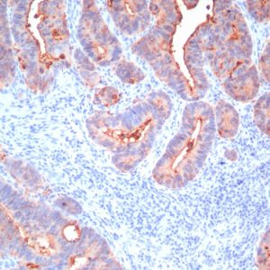 Formalin-fixed, paraffin-embedded human colon carcinoma stained with CEA Mouse Monoclonal Antibody (C66/1009).