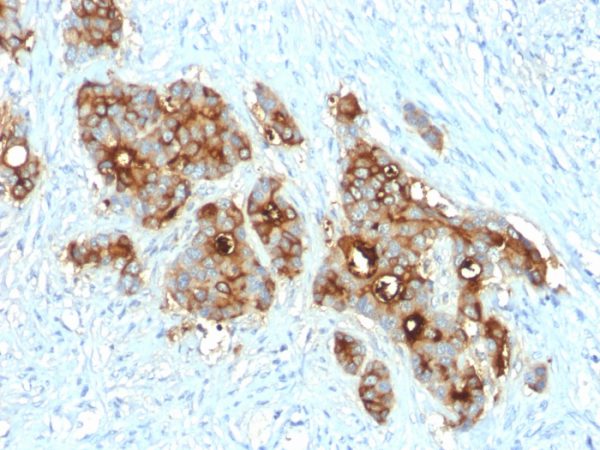Formalin-fixed, paraffin-embedded human colon carcinoma stained with CEA Rabbit Recombinant Monoclonal Antibody (C66/2055R).