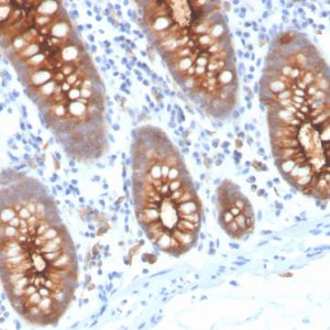 Formalin-fixed, paraffin-embedded human colon stained with CEA Recombinant Rabbit Monoclonal Antibody (C66/3707R).