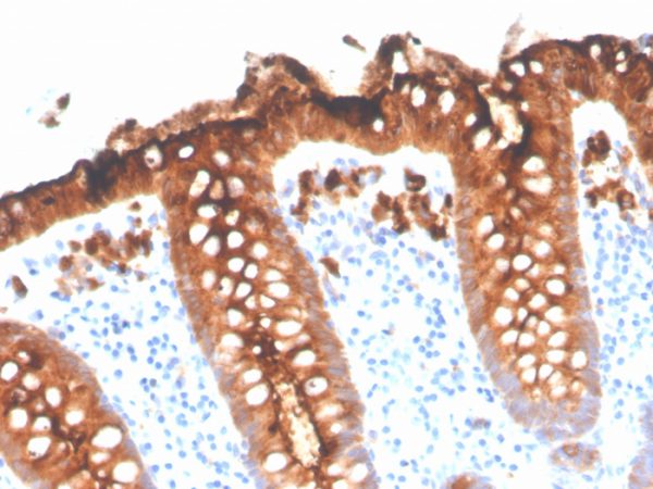 Formalin-fixed, paraffin-embedded human colon stained with CEA Recombinant Rabbit Monoclonal Antibody (C66/3707R).