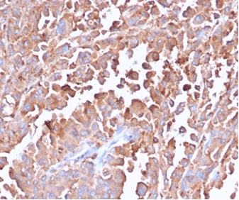 Formalin-fixed, paraffin-embedded human colon stained with CEA Rabbit Recombinant Monoclonal Antibody (C66/6470R).