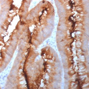 Formalin-fixed, paraffin-embedded human colon carcinoma stained with CEA Rabbit Polyclonal Antibody.