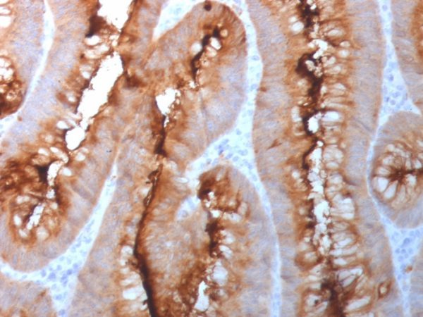 Formalin-fixed, paraffin-embedded human colon carcinoma stained with CEA Rabbit Polyclonal Antibody.
