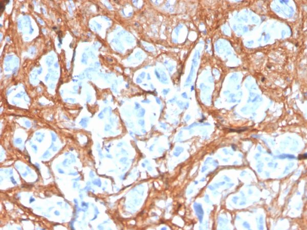 Formalin-fixed, paraffin-embedded human colon carcinoma stained with Periostin (POSTN) Mouse Monoclonal Antibody (POSTN/3503).