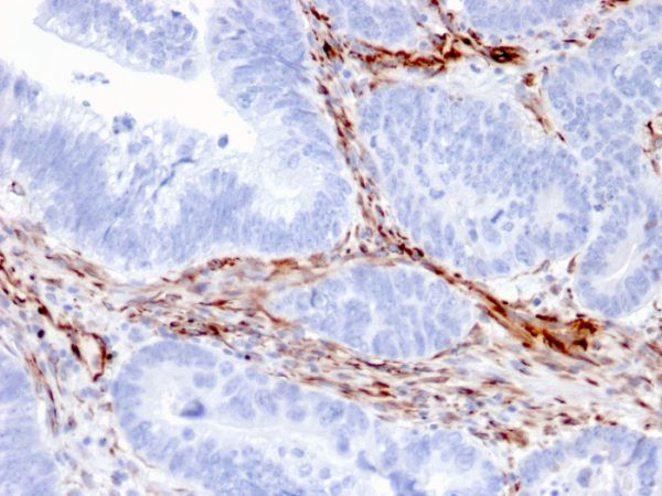 Formalin-fixed, paraffin-embedded human Colon Carcinoma stained with Nestin Mouse Monoclonal Antibody (NES/2911).