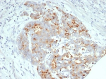 Formalin-fixed, paraffin-embedded human ovarian carcinoma stained with CFTR Recombinant Rabbit Monoclonal Antibody (CFTR/7003R). Inset: PBS instead of primary antibody; secondary only negative control.
