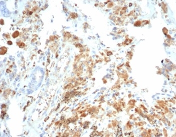 IHC analysis of formalin-fixed, paraffin-embedded human lung carcinoma. Stained using CFTR/7154R at 2ug/ml. HIER: Tris/EDTA, pH9.0, 45min. HIER: Tris/EDTA, pH9.0, 45min. 2 °: HRP-polymer, 30min. DAB, 5min.