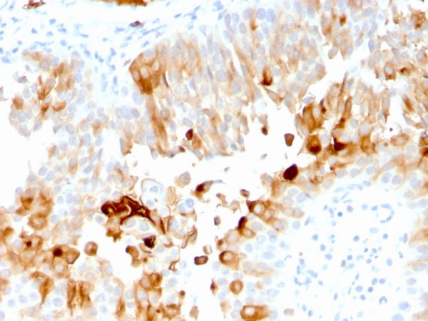 Formalin-fixed, paraffin-embedded human Urothelial Carcinoma stained with Uroplakin 1A Mouse Monoclonal Antibody (UPK1A/2921).