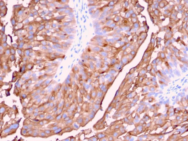 Formalin-fixed, paraffin-embedded human Urinary Bladder stained with Uroplakin 1A Mouse Monoclonal Antibody (UPK1A/2921).