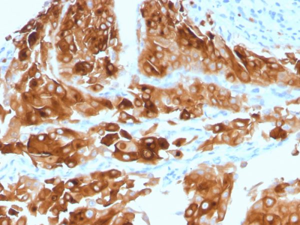 Formalin-fixed, paraffin-embedded human Urothelial Carcinoma stained with Uroplakin 1A Mouse Monoclonal Antibody (UPK1A/2921).