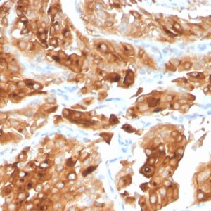 Formalin-fixed, paraffin-embedded human Urothelial Carcinoma stained with Uroplakin 1A Mouse Monoclonal Antibody (UPK1A/2922).