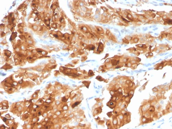 Formalin-fixed, paraffin-embedded human Urothelial Carcinoma stained with Uroplakin 1A Mouse Monoclonal Antibody (UPK1A/2922).