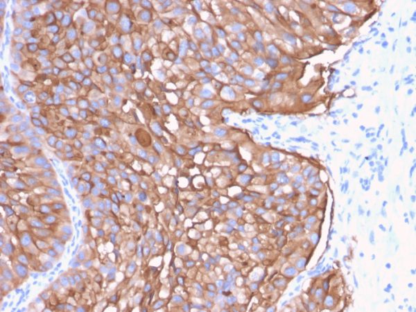 Formalin-fixed, paraffin-embedded human Bladder stained with Uroplakin 1A Mouse Monoclonal Antibody (UPK1A/2922).