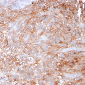 Formalin-fixed, paraffin-embedded human Urothelial Carcinoma stained with Uroplakin 1A Mouse Monoclonal Antibody (UPK1A/2925).