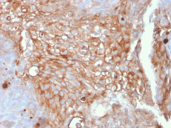 Formalin-fixed, paraffin-embedded human Urothelial Carcinoma stained with Uroplakin 1A Mouse Monoclonal Antibody (UPK1A/2925).