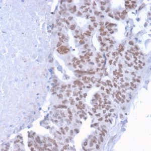 Formalin-fixed, paraffin-embedded human Breast Carcinoma stained with CHD4 Mouse Monoclonal Antibody (3F2/4).